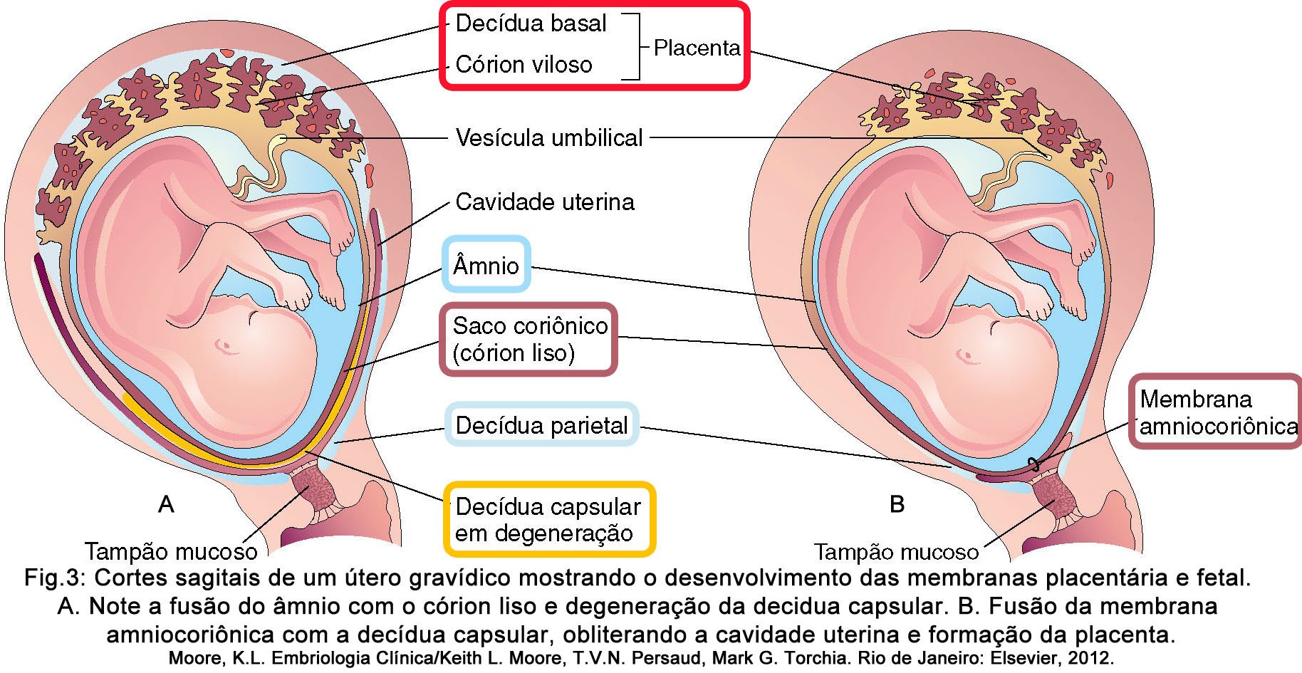 rotura prematura membranas ovulares